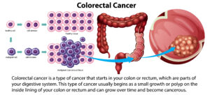 Colorectal Cancer Treatments in Mumbai