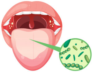 Oral Cancer Treatment in Mumbai