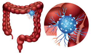 best oncologist surgeon in Mumbai