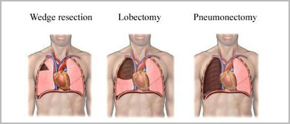Lung Cancer Surgery