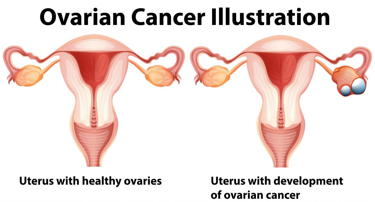 ovarian-cancer-anil-cancer-clinic