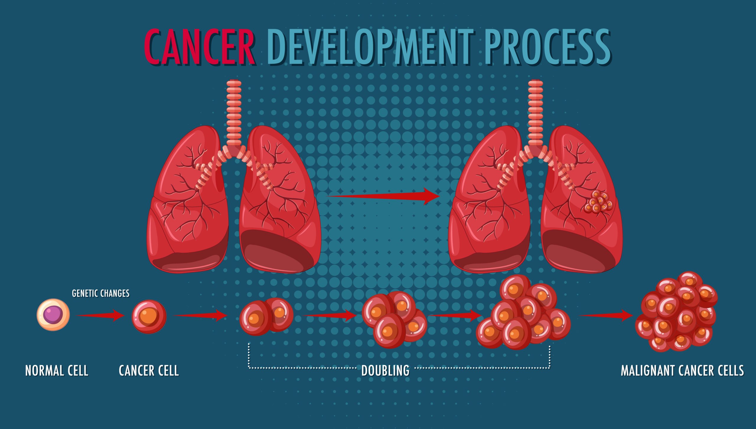 lung cancer