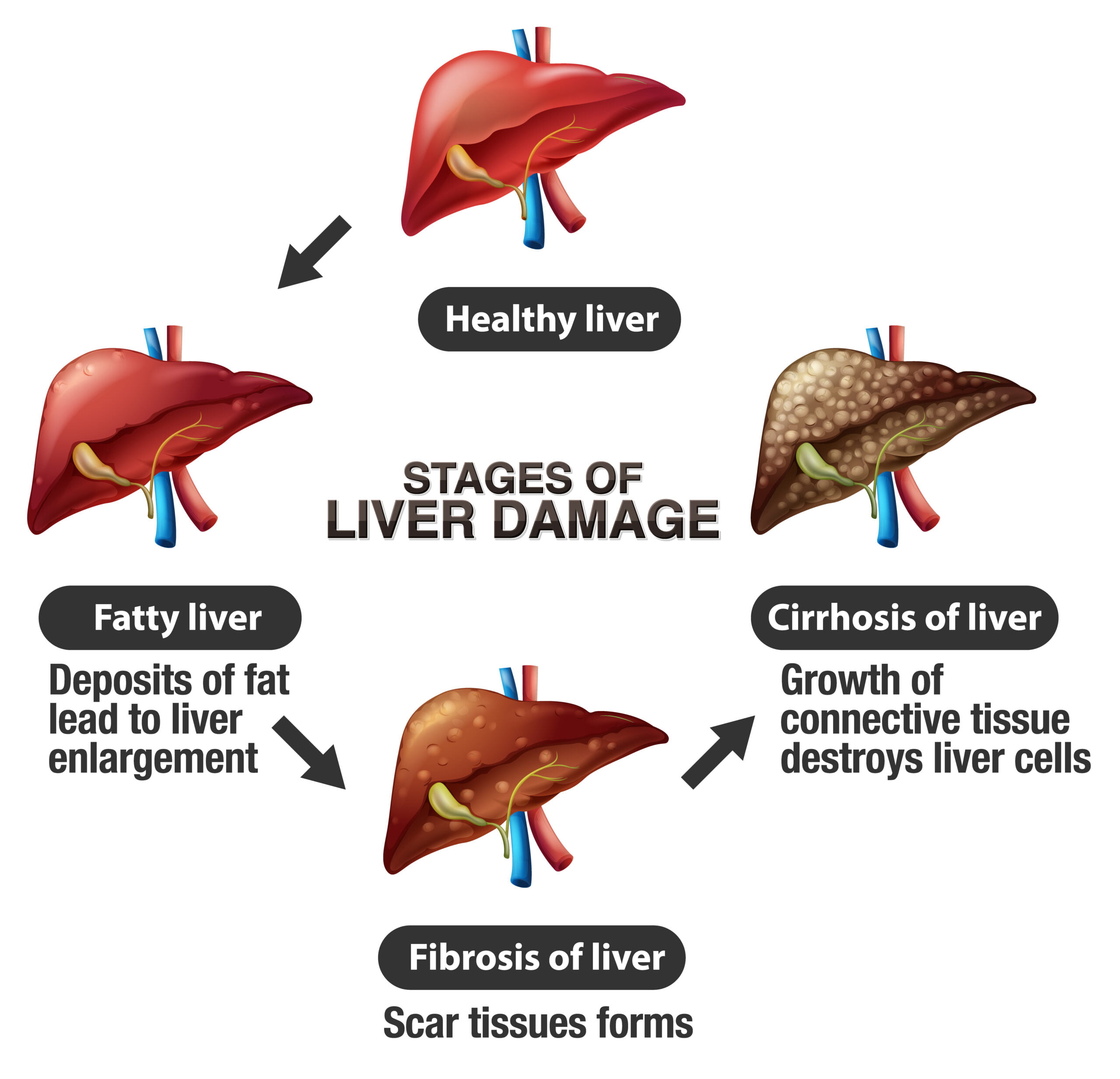 Liver Cancer