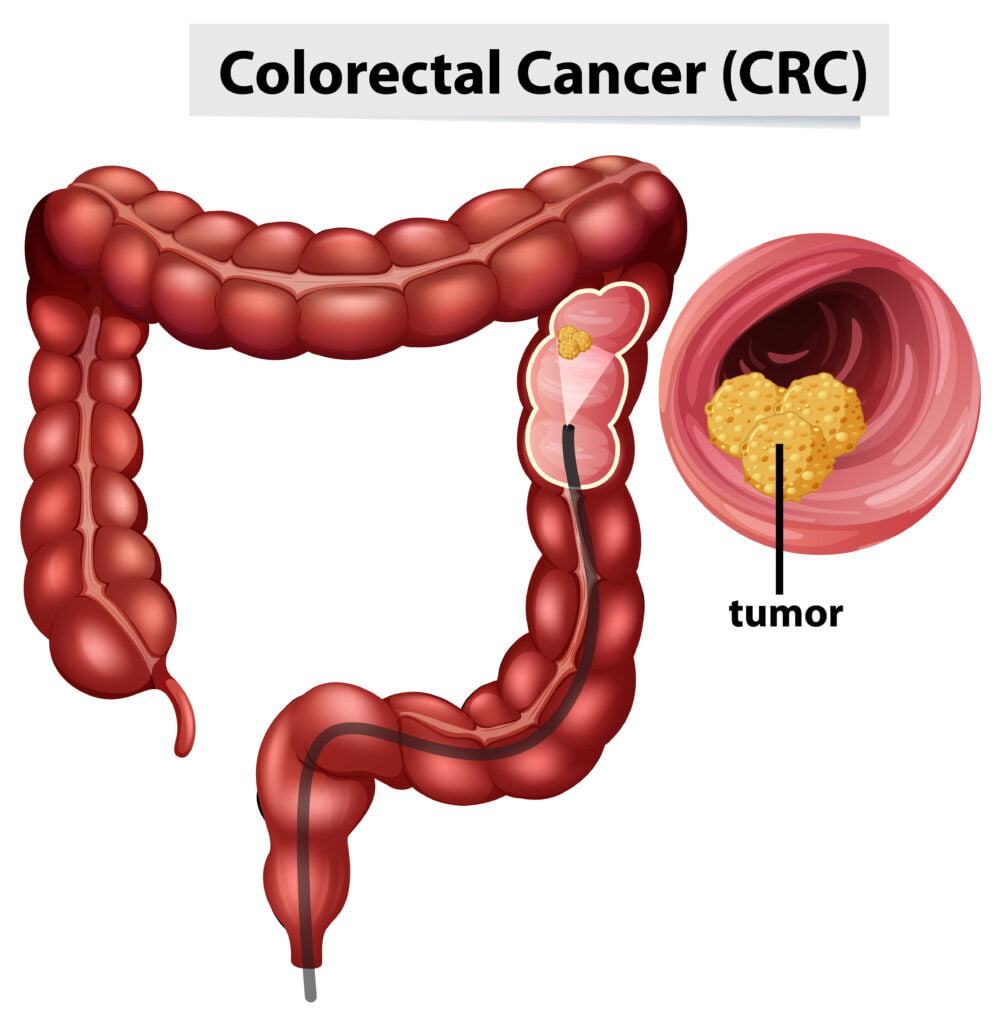 Understanding Colorectal Cancer