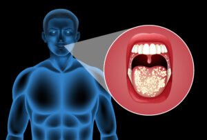 Mouth Cancer Treatment in Mumbai